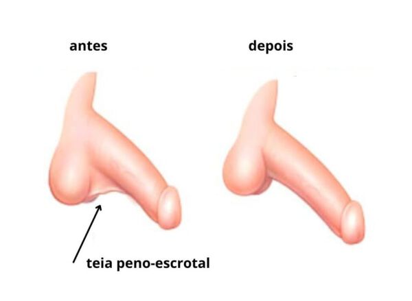 Antes e depois da Correção Teia Peno-Escrotal