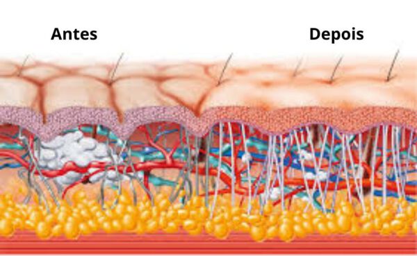 Terapia com Ondas de Choque - Antes e Depois