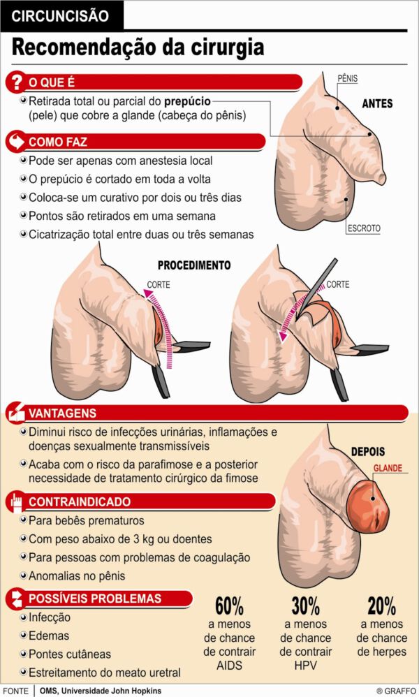 Ilustração sobre o procedimento de postectomia - cirurgia de fimose