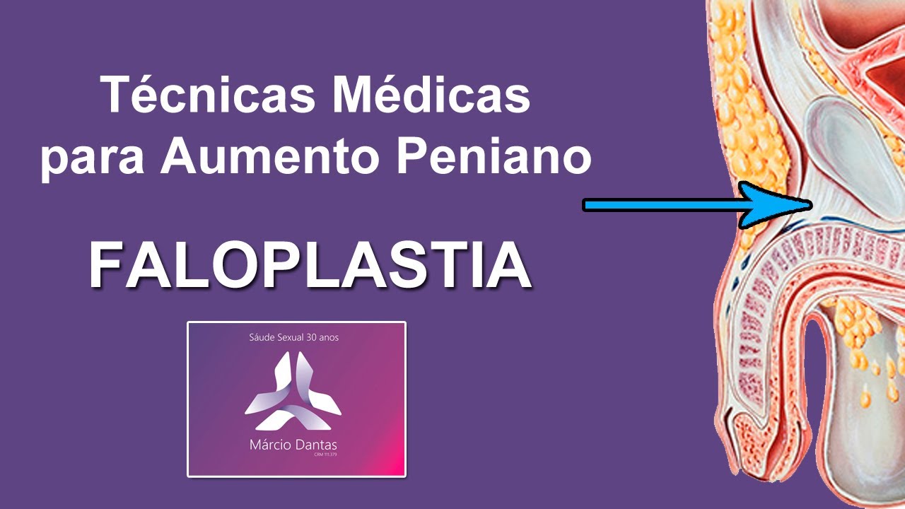 faloplastia cirurgia para aumento peniano secção ligamento suspensor do pênis dr. marcio dantas de menezes