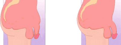 lipoaspiração pubiana masculina antes e depois