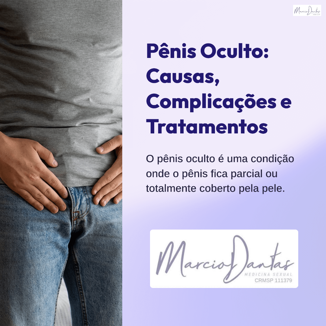 Penis-Oculto-Pênis-Escondido-Causas-Complicacoes-e-Tratamentos-Dr. Marcio Dantas de Menezes
