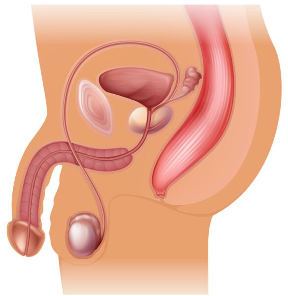 magem ilustrativa de implante peniano