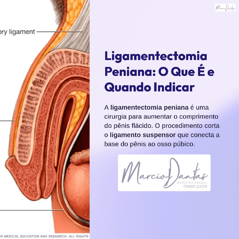 Ligamentectomia Peniana: O Que É e Quando Indicar