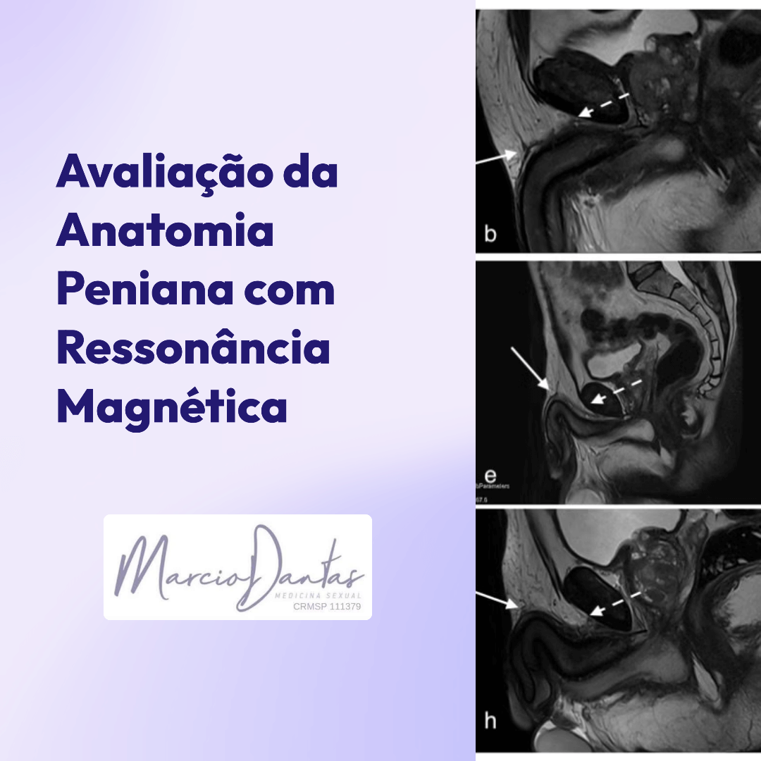 Avaliacao-da-Anatomia-Peniana-Ligamento-Suspensor-do-Pênis-com-Ressonancia-Magnetica-Dr. Marcio Dantas de Menezes