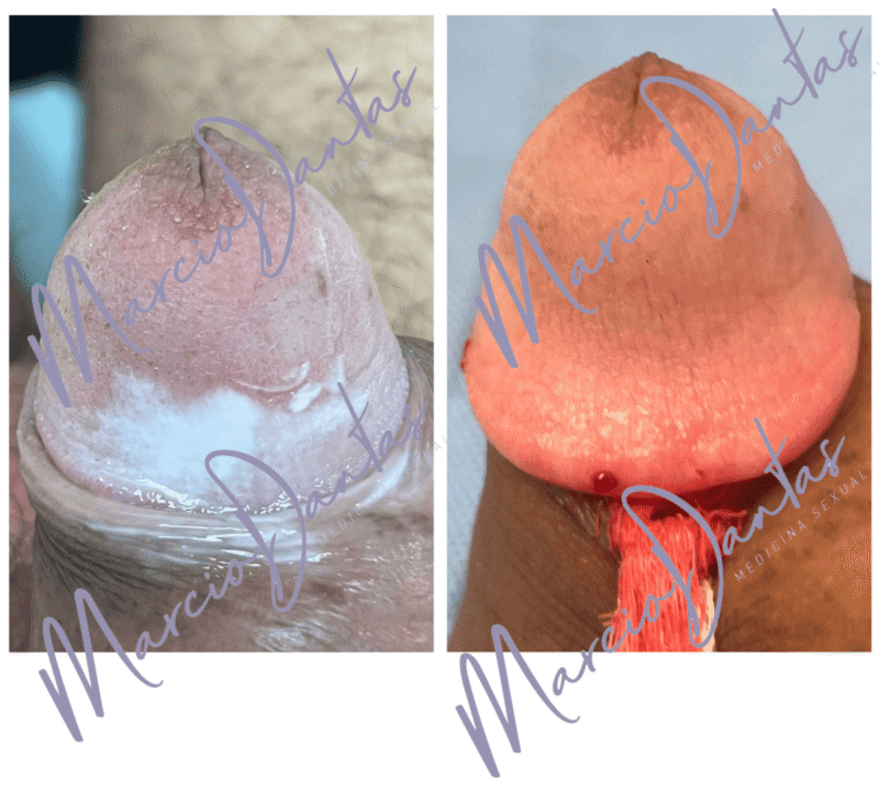Resultado de aumento de glnde com ácido hialurônico. À esquerda foto de antes e à direita foto depois do procedimento com ganho no tamanho da glande Dr. Marcio Dantas de Menezes